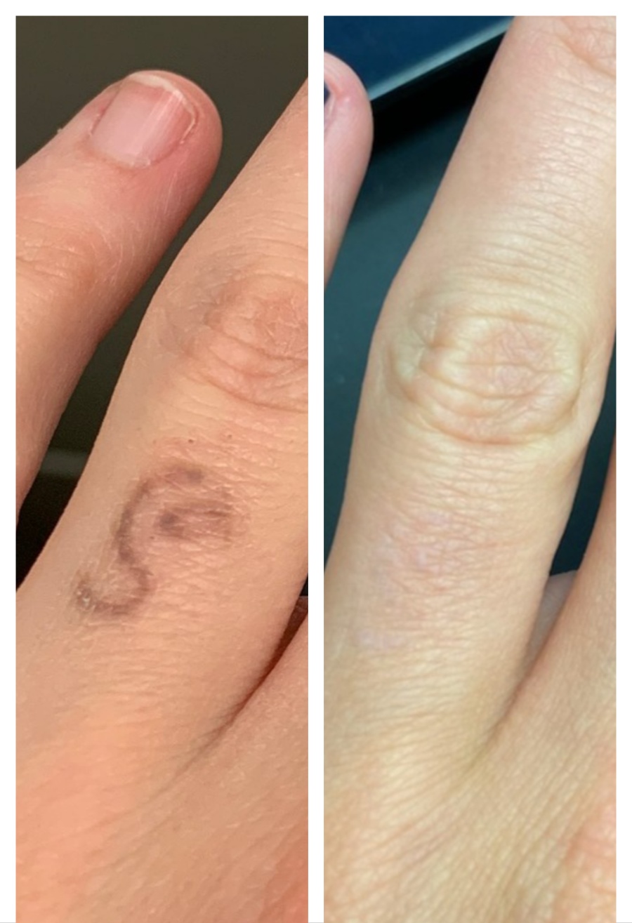 Ring Tattoo After